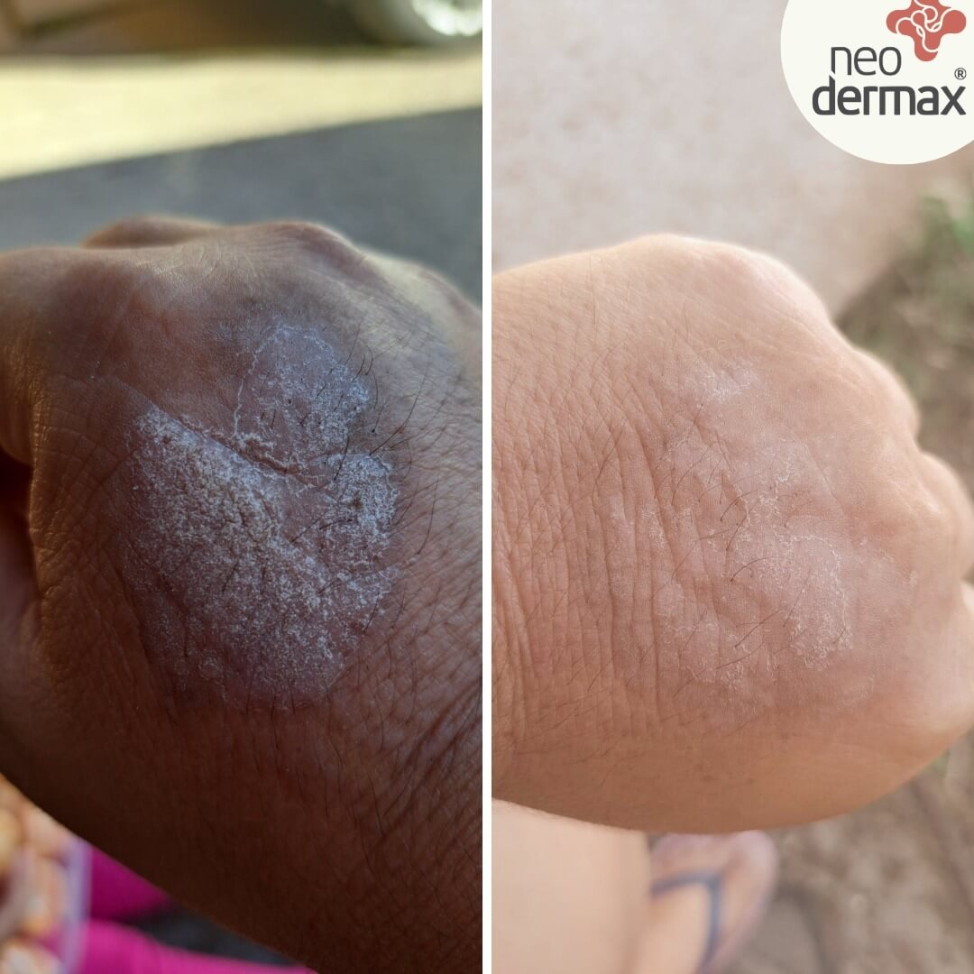 antes e depois neodermax (1)