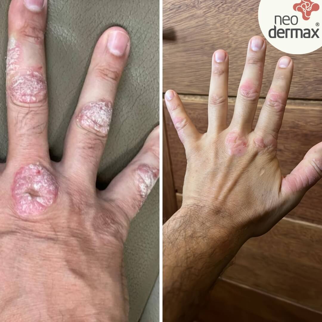 antes e depois neodermax (2)