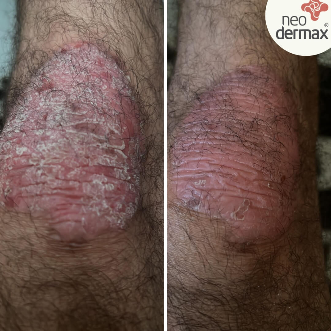 antes e depois neodermax (3)