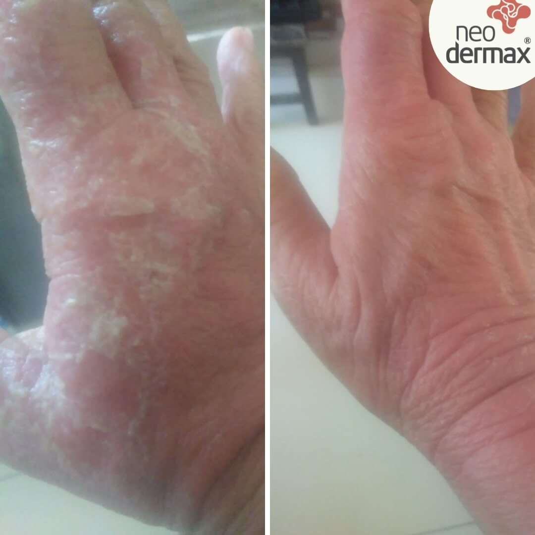 antes e depois neodermax (4)