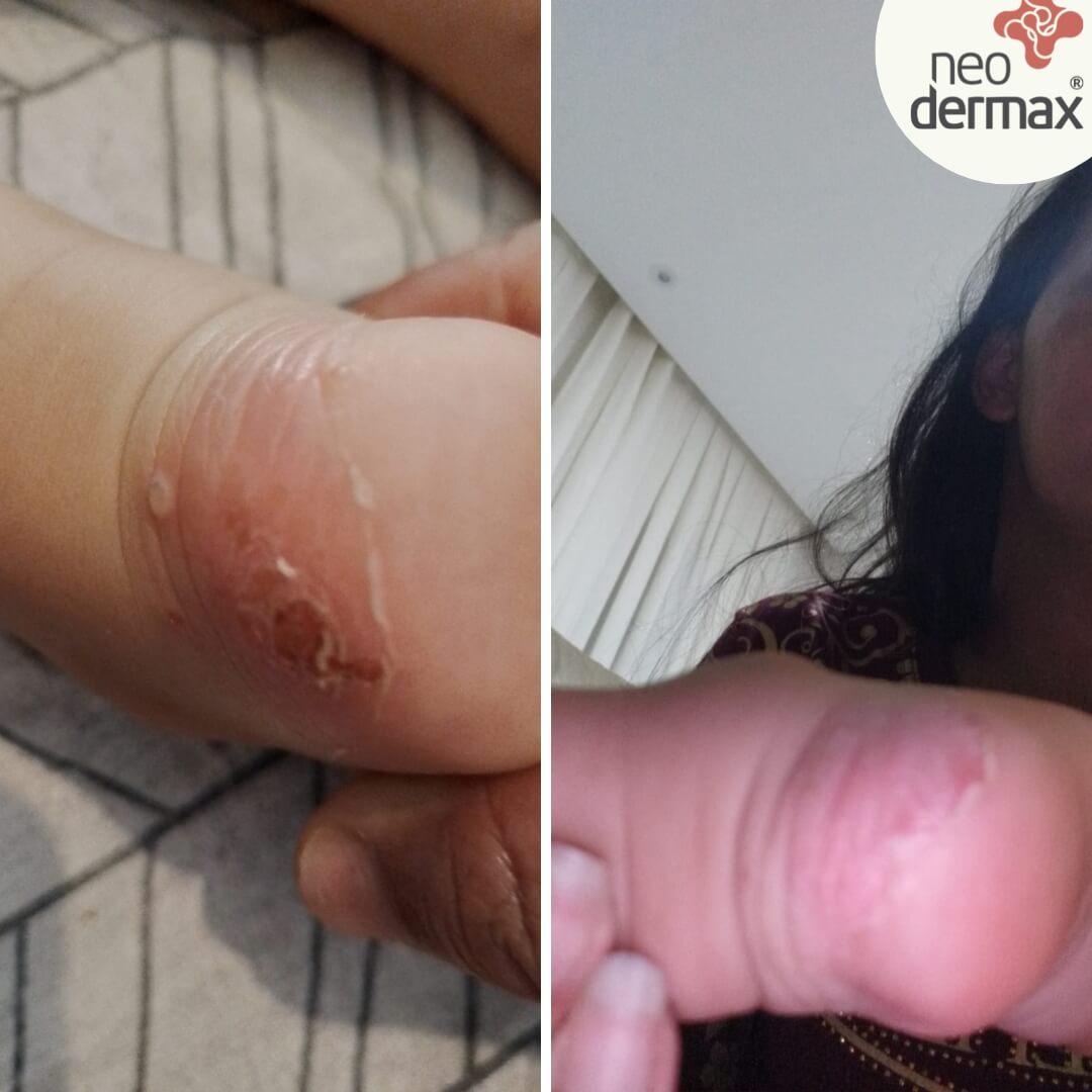 antes e depois neodermax (5)