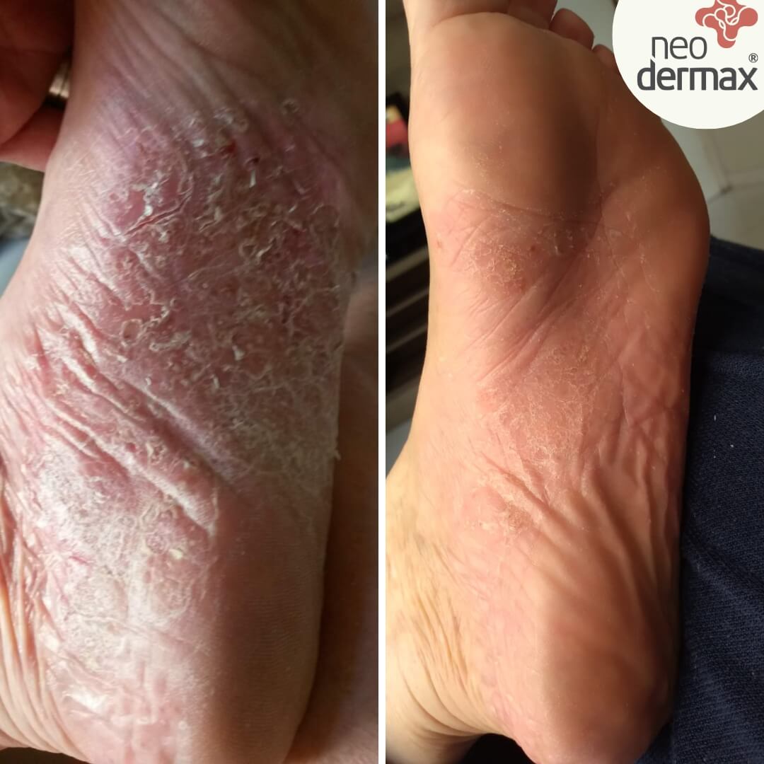 antes e depois neodermax (6)