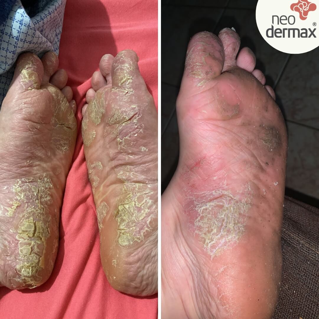 antes e depois neodermax (7)